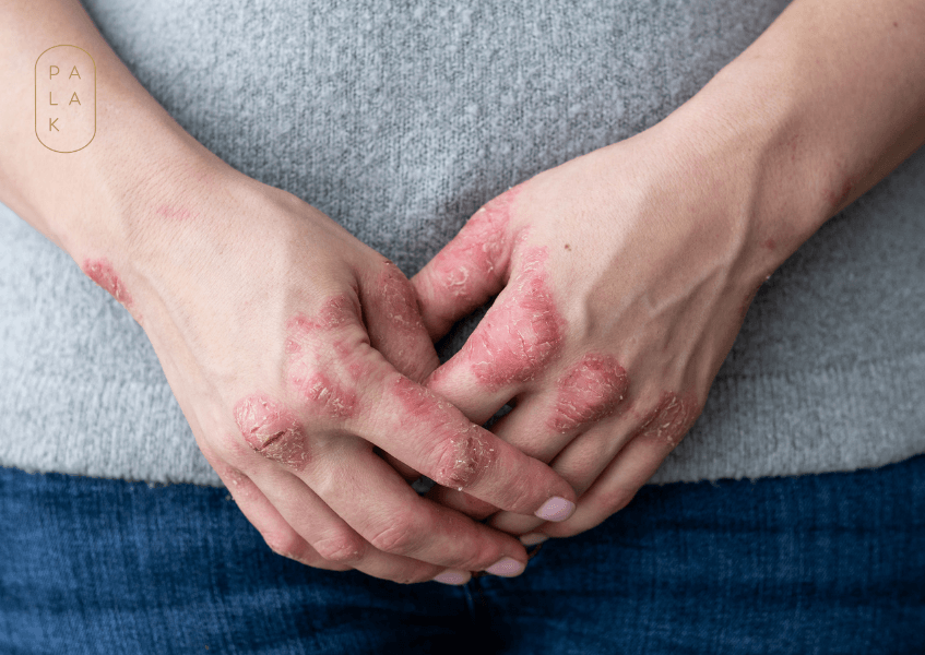 How to Get Instant Relief For Eczema Itch: A Permanent Solution - Palak Notes