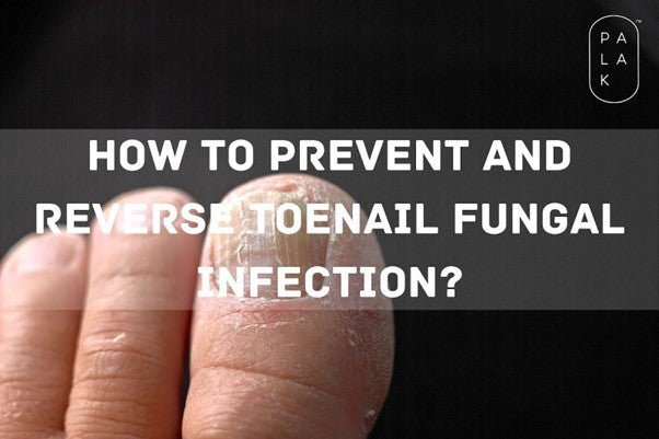 How to Prevent and Reverse a Toenail Fungal Infection? - Palak Notes