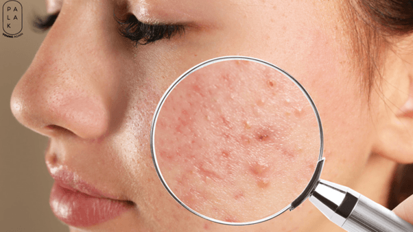 How to Remove Pimples Naturally and Permanently - Palak Notes