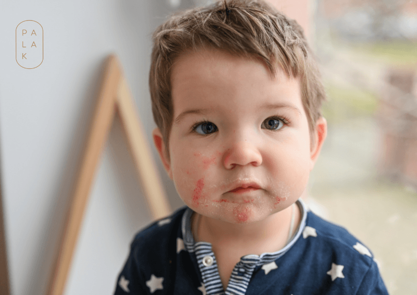 Your Baby Eczema Causes and Triggers & How to Get Rid Of It - Palak Notes